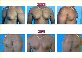 Gynecomastia - Before and after - 1