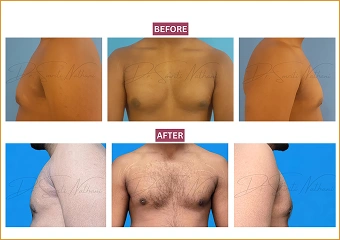 Gynecomastia - Before and after - 2