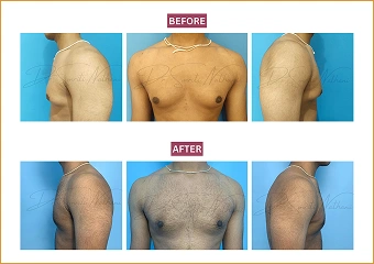 Gynecomastia - Before and after - 3