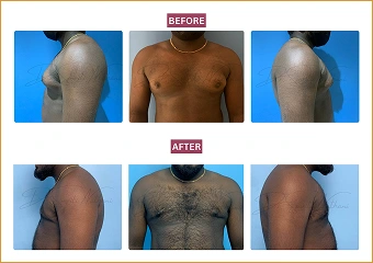 Gynecomastia - Before and after - 4