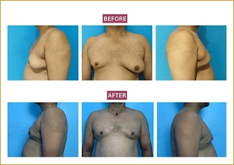 Gynecomastia - Before and after - 5