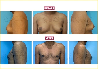 Gynecomastia - Before and after - 6
