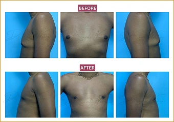 Gynecomastia - Before and after - 7