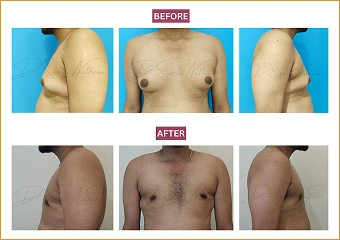 Gynecomastia - Before and after - 8