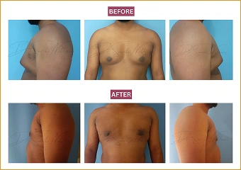 Gynecomastia - Before and after - 9