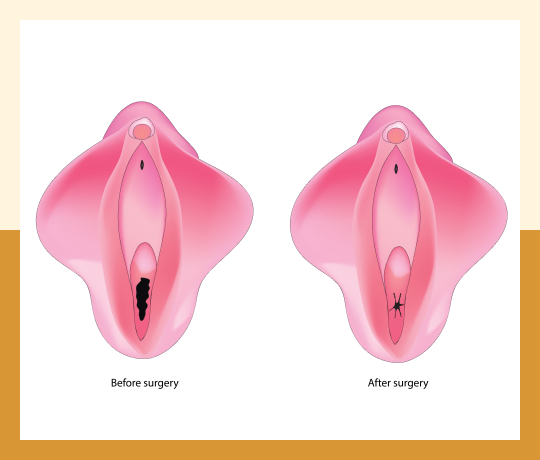 Hymenoplasty 