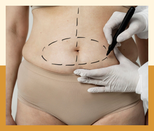 Hernia surgery with tummy tuck 