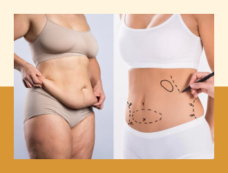 Lip Abdominoplasty / tummy tuck 