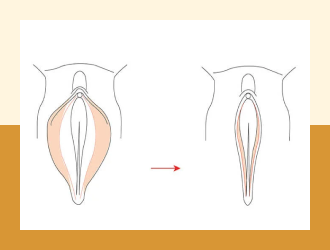 Vaginoplasty (surgical / non-surgical) 