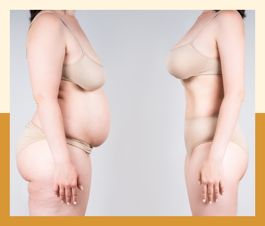 Breast augmentation
                                (Enhancement) - Fat grafting