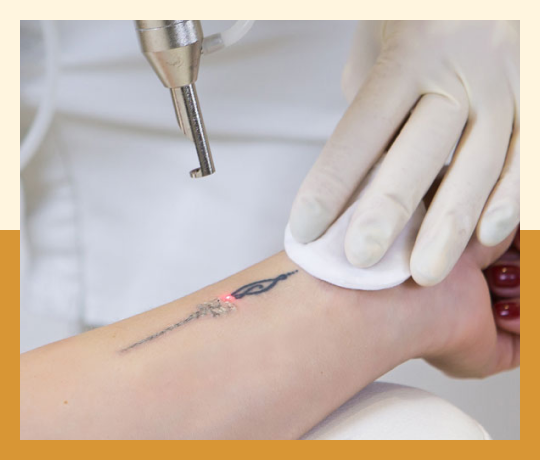 Lasers (Resurfacing, tattoo removal)