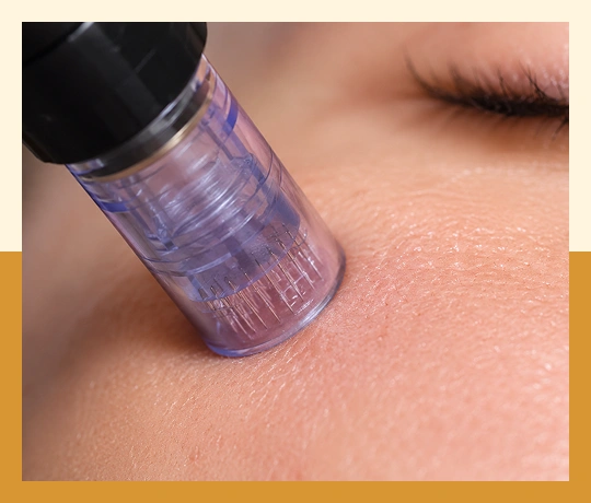 Morpheus8 radiofrequency microneedling improving skin tightening, texture, and collagen renewal.