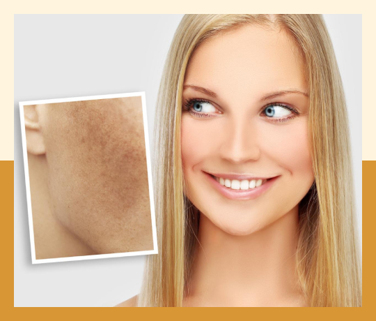 Melasma treatment