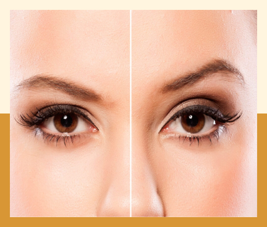 Brow lift 