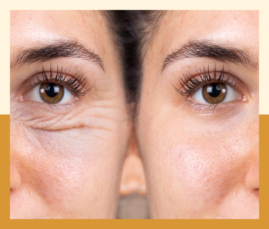 Blepharoplaster (eyelid)