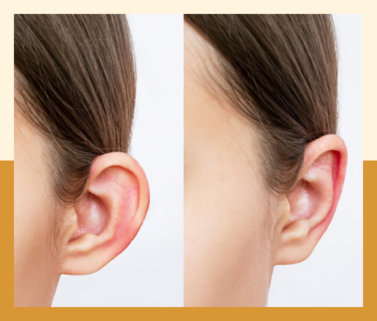 Ear reshaping surgery / otoplasty 