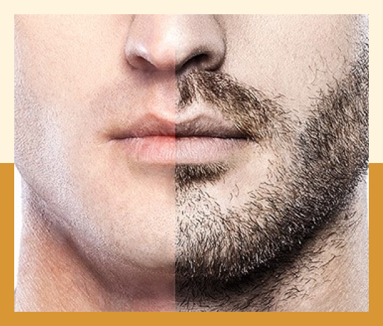 Beard hair transplant