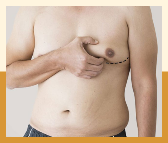 Gynecomastia surgery