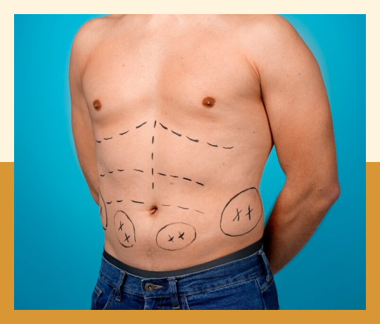  Liposuction