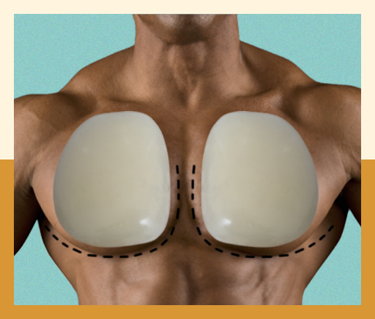 Pectoral implant (chest Implant)