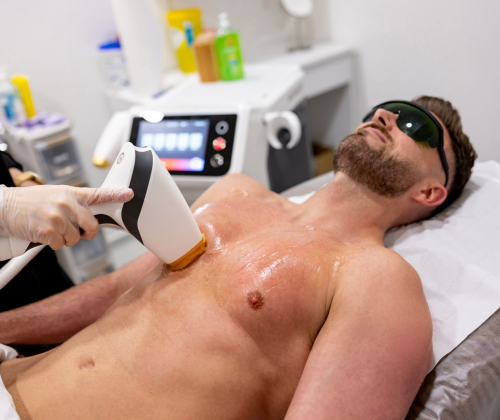 Laser hair removal