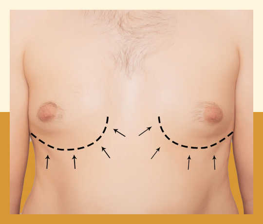 gynecomastia